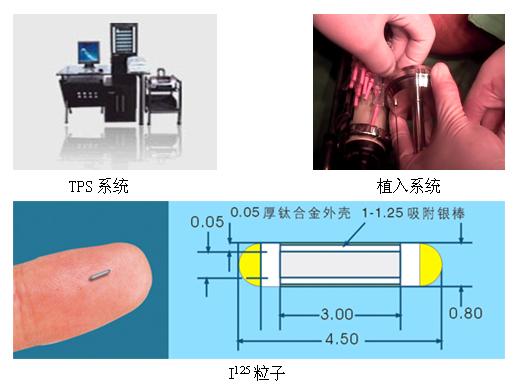 什么是放射性粒子植入？