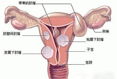 子宫肌瘤